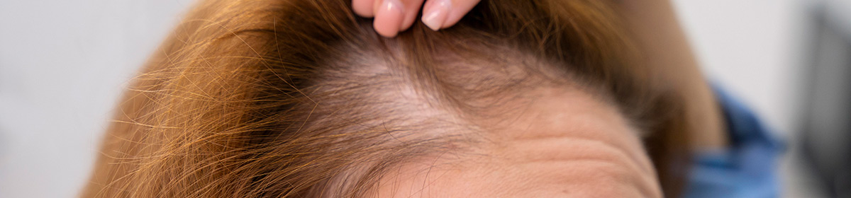 Alopecia é uma condição genética