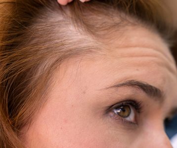 Alopecia é uma condição genética